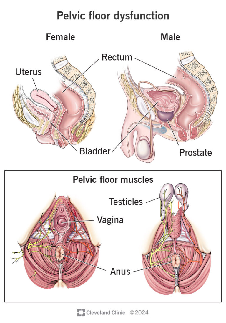 What Causes Tight Pelvic Floor Muscles
