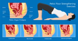 What is a Pelvic Floor Therapist