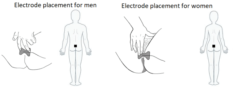 Where to Place Tens Pads for Pelvic Floor