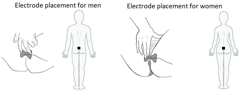 Where to Place Tens Pads for Pelvic Floor